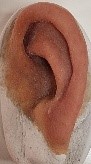 Proteza-partiala-auriculara-de-silicon