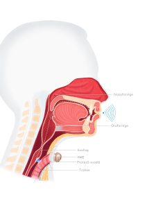 Provox - ilustratie de laringectomie