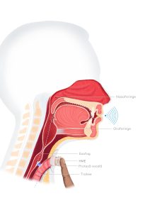 Provox - ilustratie de laringectomie